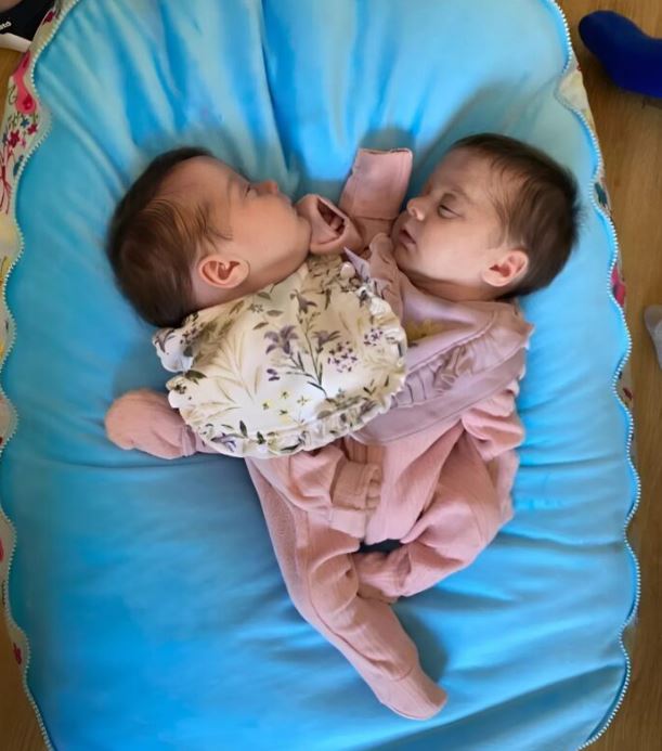 Thanks to the doctors, the Siamese twins were separated, and here’s what they look like 3 years later: children who move and inspire everyone.