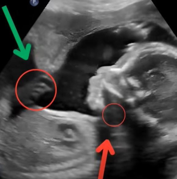 We were joyfully awaiting our second child when the doctor’s words shattered our world. In one quiet room, hope turned into fear, and our future suddenly felt uncertain, fragile, and painfully real.