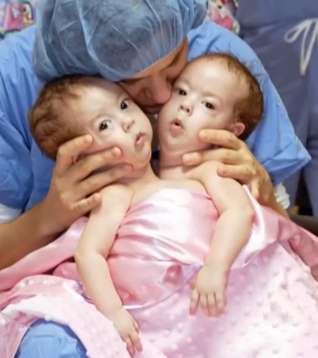 Conjoined Twins Bella And Abby Were Genuinely Associated From Birth, Yet Medical Procedure Changed Everything